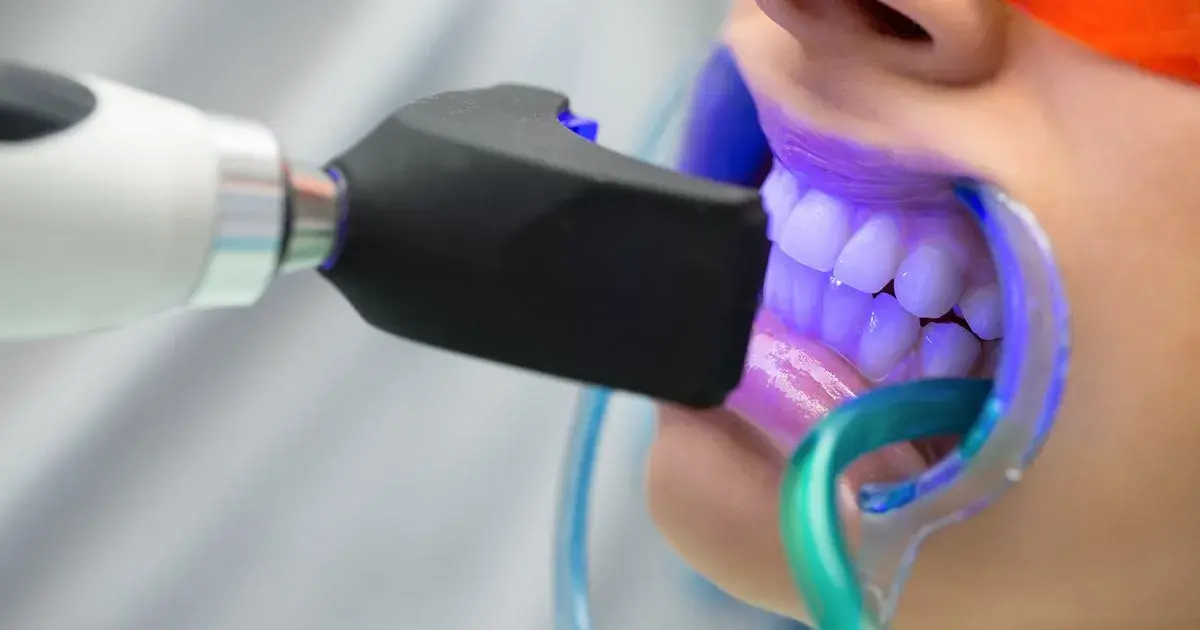 Imagen del servicio de Blanqueamiento dental